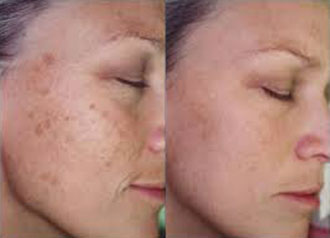 Traitement des taches pigmentaires du visage