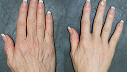 Rajeunissement des mains par injection d'Acide Hyaluronique