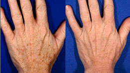 Traitement des taches pigmentaires des mains